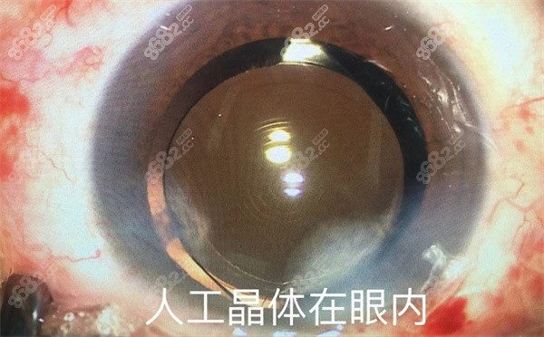 近视1600度可以做手术吗