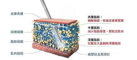 南阳薇美整形做全身吸脂手术好