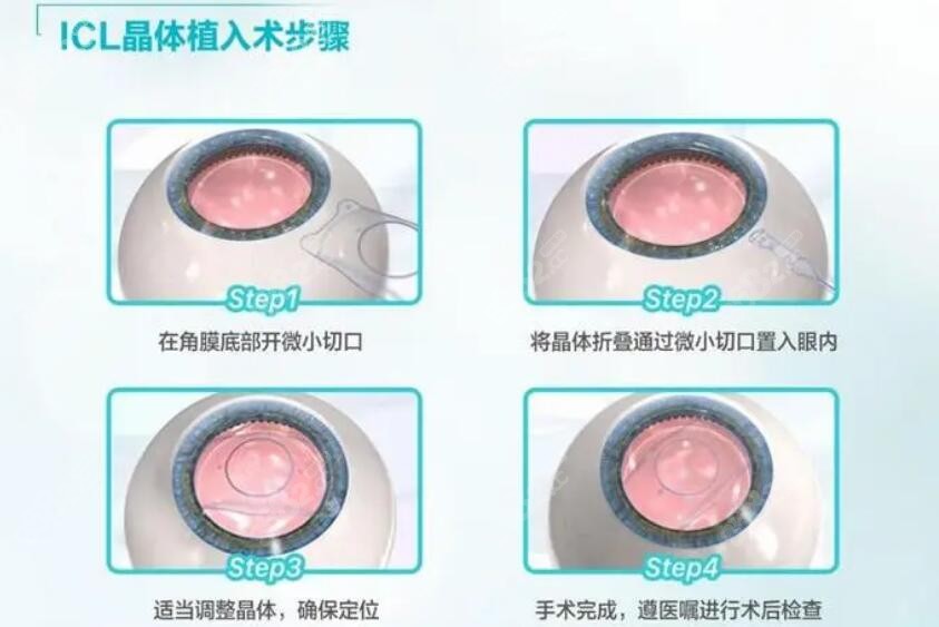 ICL晶体植入矫正度数：近视1800度以内顾客