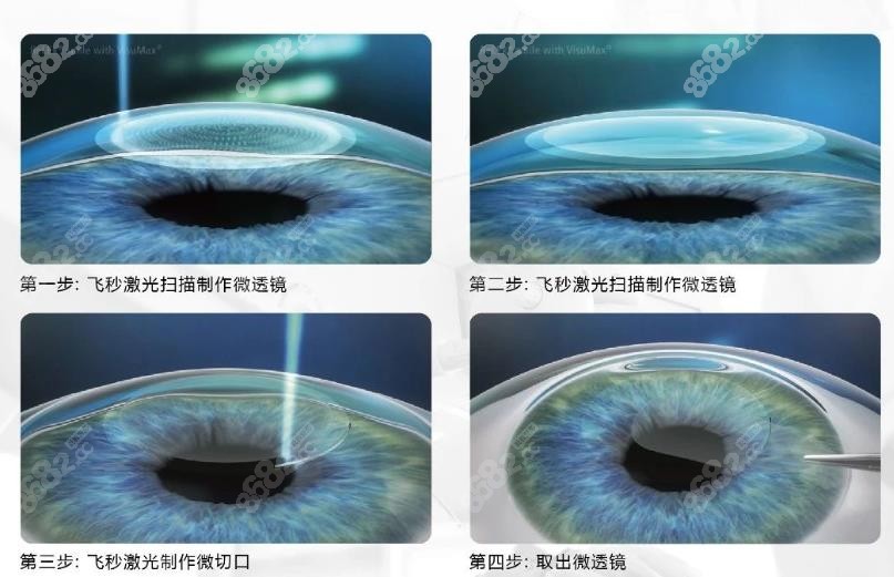 重庆华厦眼科医院飞秒激光近视眼手术价格