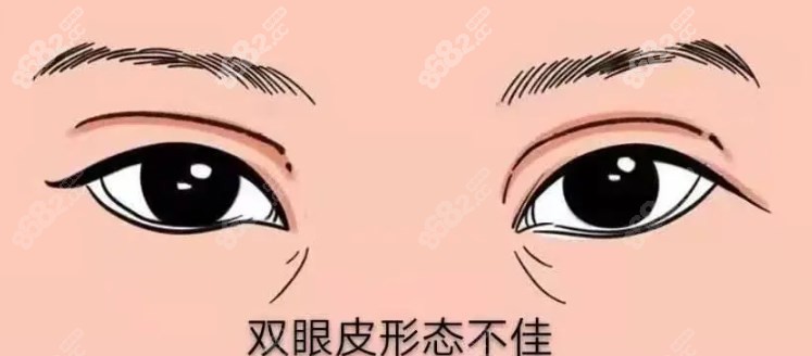 师丽丽双眼皮修复评价