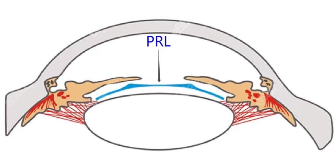 东莞爱尔眼科医院PRL晶体植入收费-8682网站