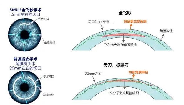 河南省全飞秒手术