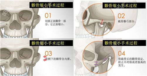 刘先超医生颧骨降低手术操作方式