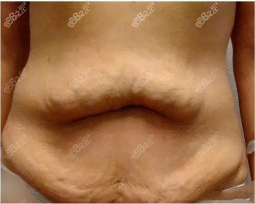 小编梁安裕腹壁成型大概多少钱8682.cc
