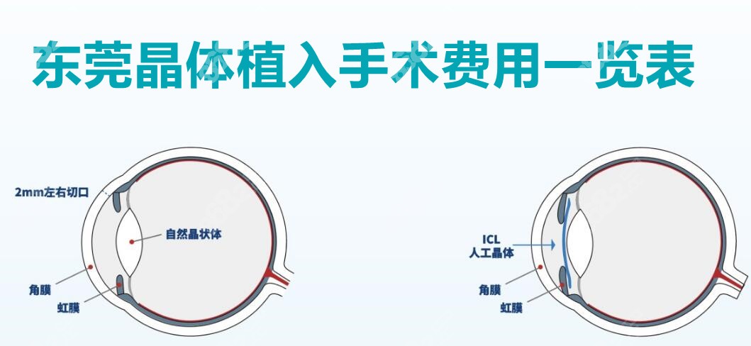 东莞晶体植入手术费用一览表2023年