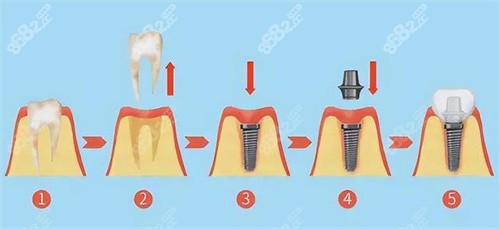 种植牙手术流程图