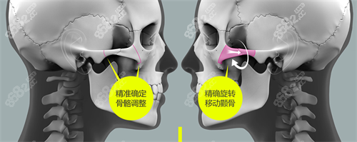 北京圣嘉新医疗美容医院张笑天医生颧骨截骨示意图