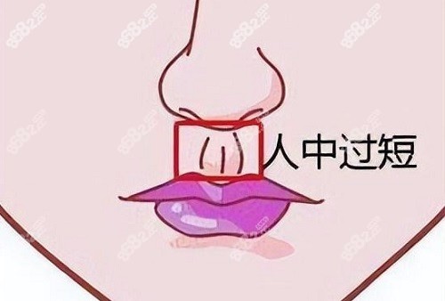 北京画美马群医生人中缩短价格贵吗