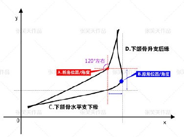 北京圣嘉新医疗美容医院张笑天医生下颌角截骨位置线形图