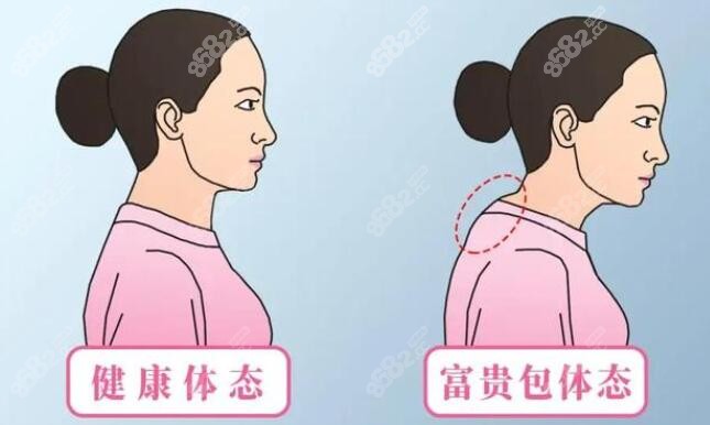 健康体态和富贵包体态对比