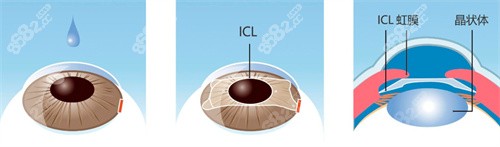 icl晶体植入手术过程图