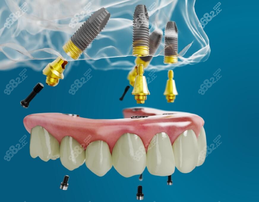 瑞典诺贝尔种植牙