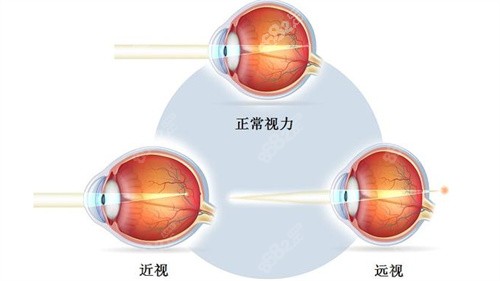 正常视力与近视对比图