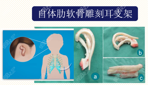 自体肋软骨雕刻耳支架