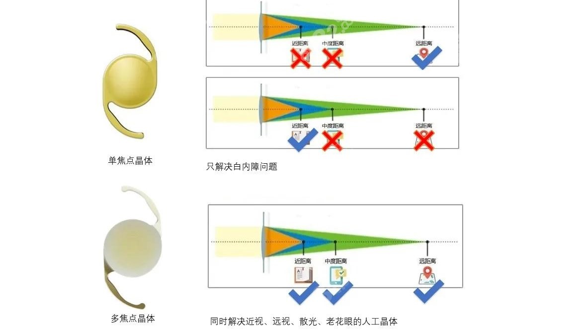 多焦点人工晶体