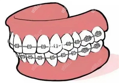 牙齿矫正展示图 牙齿矫正展示图