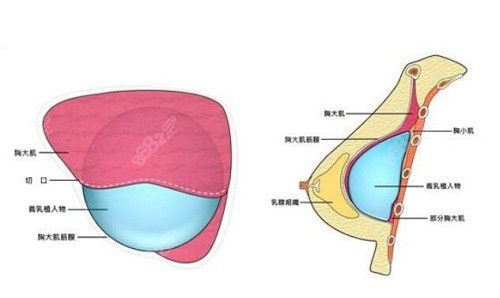 吴毅平隆胸多少钱