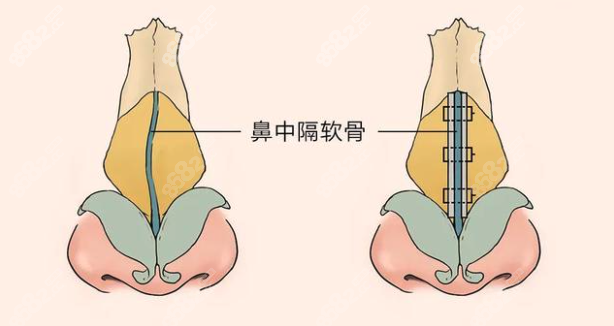 师俊莉隆鼻技术怎么样