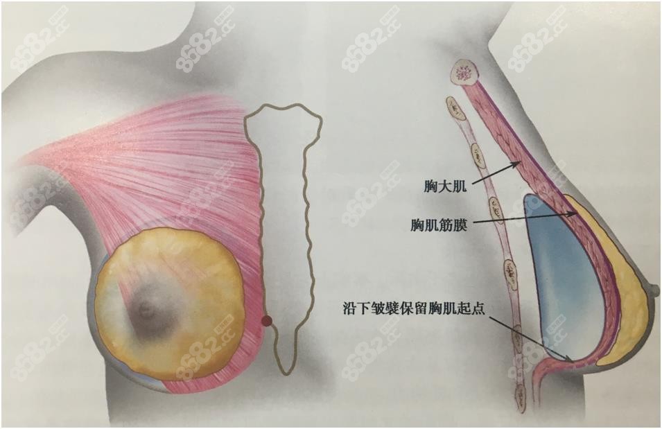 罗盛康下皱襞切口隆胸好8682.cc