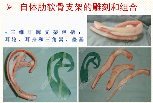 郭志华医生耳再造手术自体肋软骨雕刻