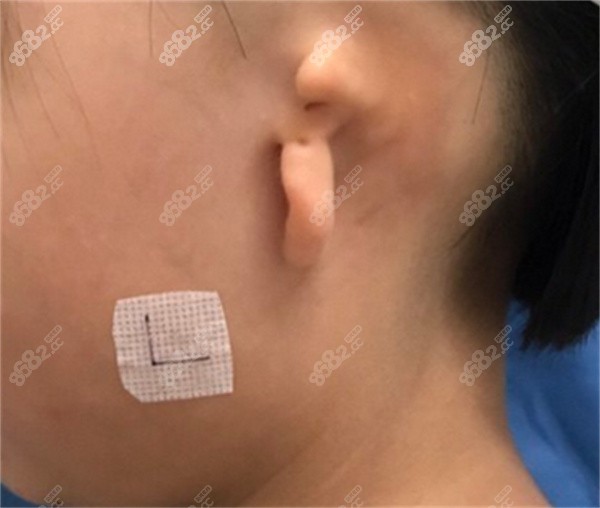 耳朵整形手术一只大概需要多少钱