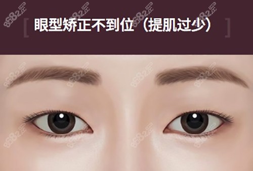 北京雙眼皮修復(fù)大概多少錢呢？北京雙眼皮修復(fù)價格中有