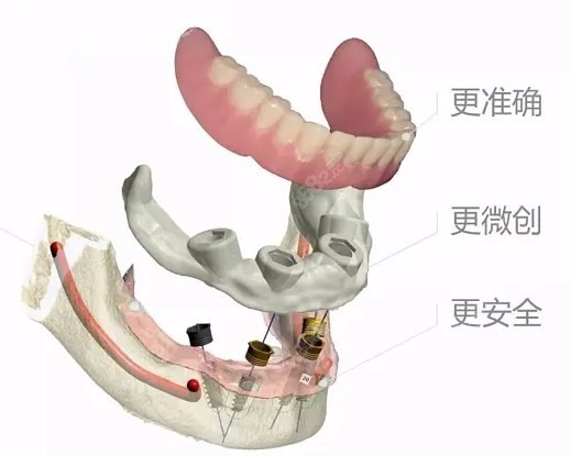即刻负重技术