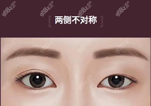 北京雙眼皮修復(fù)大概多少錢呢？北京雙眼皮修復(fù)價格中有