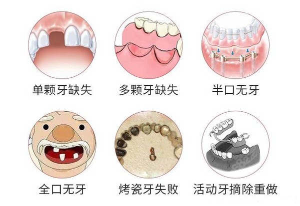 美可普口腔叶益军医生做种植牙怎么样