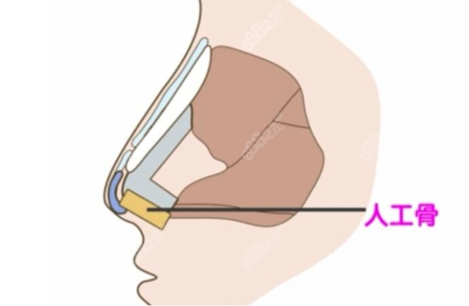 西安美萊鼻綜合技術(shù)過(guò)硬 西安美萊鼻綜合技術(shù)過(guò)硬