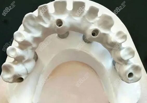 种植钛架和马龙桥一样吗