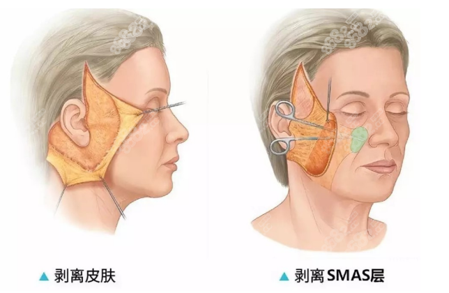 北京加减美范惟拉皮技术怎么样？