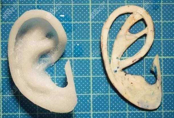 耳再造9年后耳朵图片86#82网