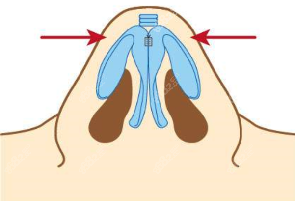 西安美萊鼻綜合技術(shù)先進(jìn) 西安美萊鼻綜合技術(shù)先進(jìn)