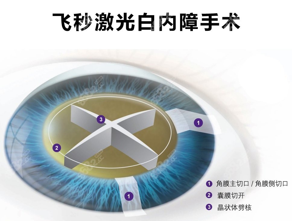 深圳爱尔眼科飞秒激光白内障手术价格