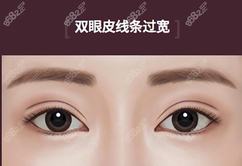 北京雙眼皮修復(fù)大概多少錢呢？北京雙眼皮修復(fù)價格中有