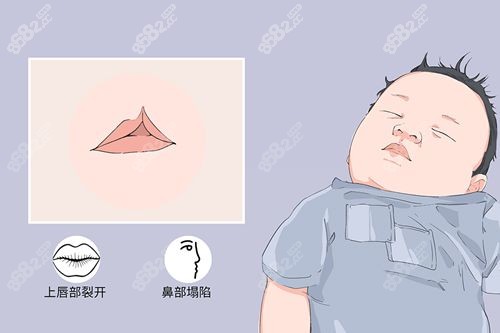 杭州正规的隐形唇裂修复医院推荐