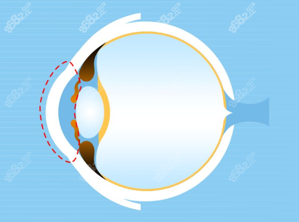 宁波眼科医院飞秒价格13800元起@8682网