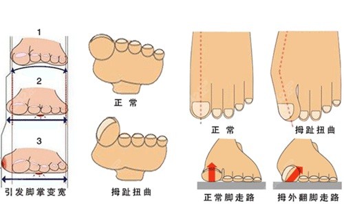 苏敬达大脚骨手术口碑评价反馈
