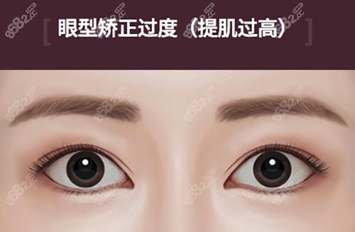 北京雙眼皮修復(fù)大概多少錢呢？北京雙眼皮修復(fù)價格中有