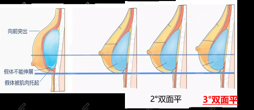 武汉艺星徐国建隆胸双平面植入