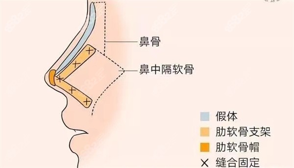 耳软骨隆鼻和肋骨隆鼻优势有哪些