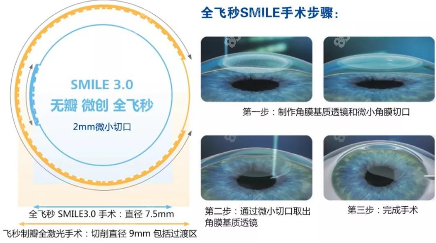 <!--<i data=20240705-sp></i>-->眼科医院做全飞秒手术过程