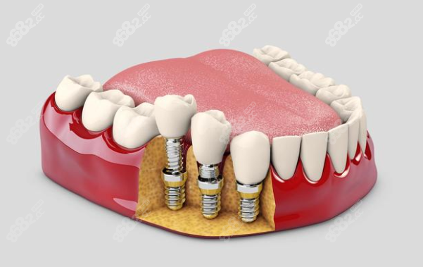 绍兴柯桥口腔医院种植牙技术怎么样 8682.cc