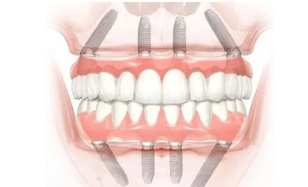满口种植牙怎么做便宜4颗