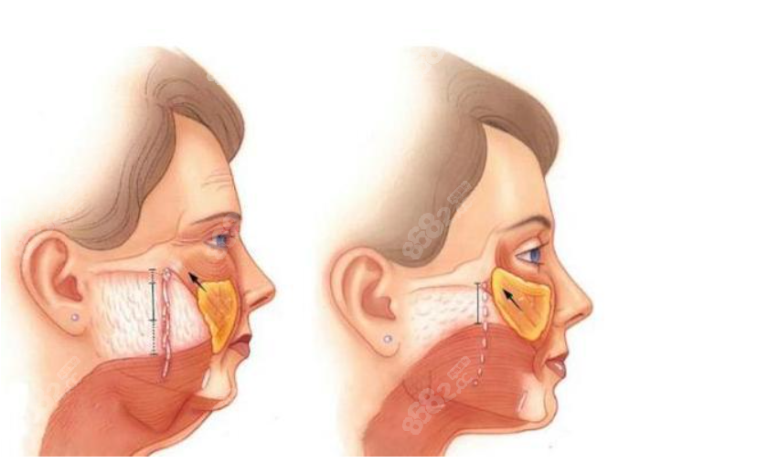 拉皮手术示意图www.8682.cc
