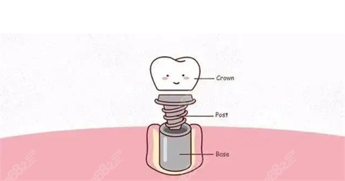 暨南雅皓口腔种植牙价格