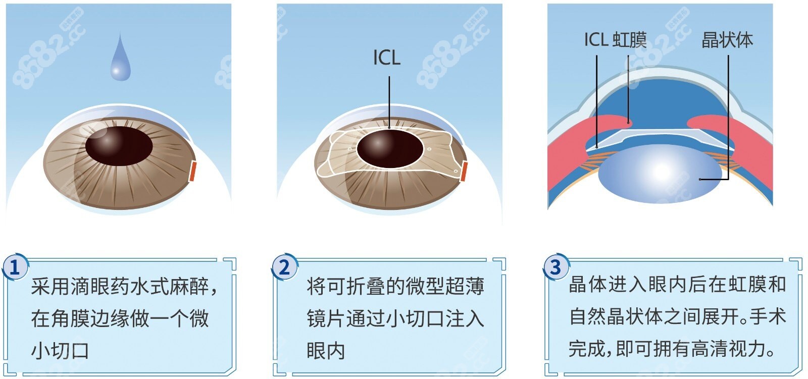 美国禁止做ICL人工晶体植入近视手术是真的吗