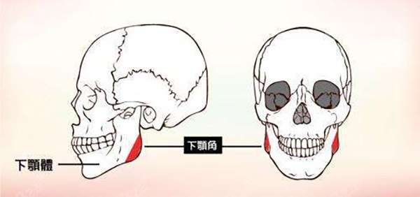 下颌角截多了怎么办